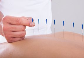 Acupuncture by Healing Edge